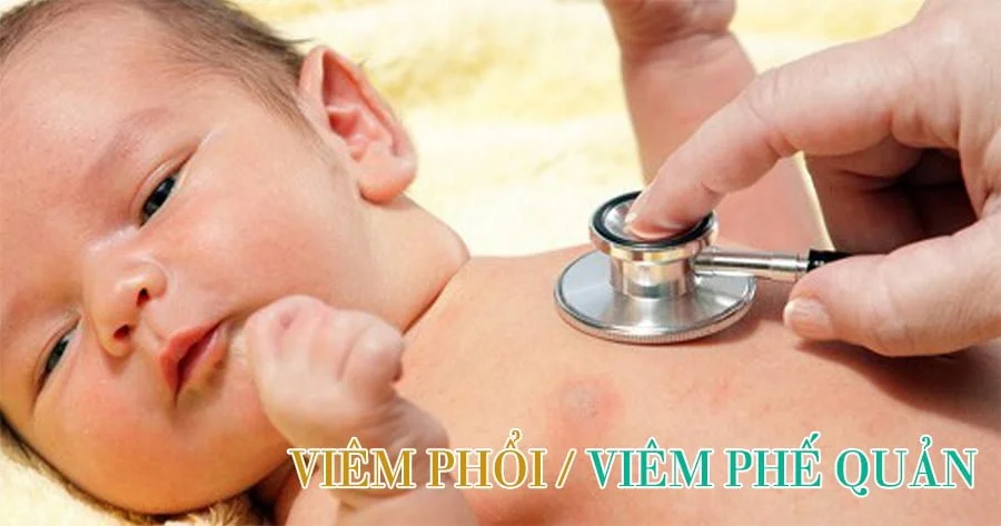 Dấu hiệu, cách nhận biết trẻ sơ sinh bị viêm phổi nguy hiểm 6 Viem phoi va viem phe quan