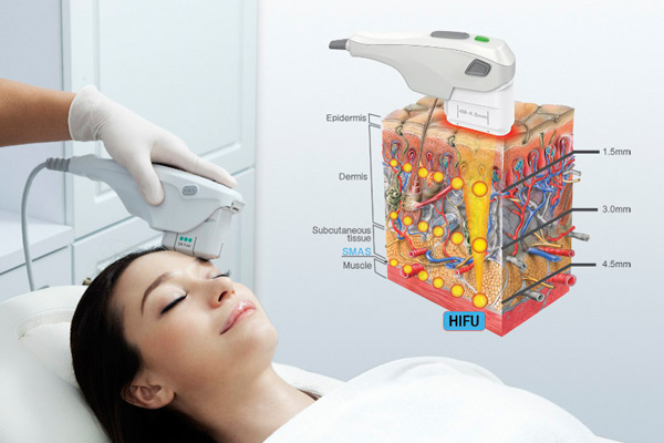 Làm đầy rãnh mũi má an toàn hiệu quả